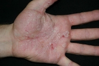 Всемирный день борьбы с псориазом